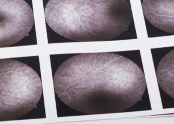 Model AI analizuje obrazy siatkówki, aby wykryć wczesne stadium choroby Alzheimera i spadek funkcji poznawczych