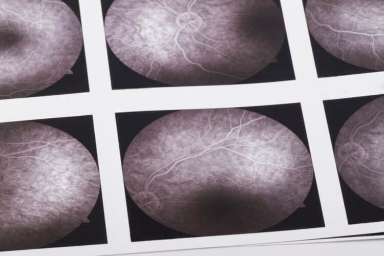 Model AI analizuje obrazy siatkówki, aby wykryć wczesne stadium choroby Alzheimera i spadek funkcji poznawczych