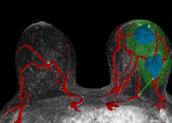 Startup wspiera chirurgów w precyzyjnym leczeniu raka piersi dzięki 3D wizualizacjom opartym na sztucznej inteligencji