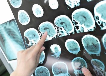 "Sztuczna inteligencja wspiera prognozowanie ryzyka udaru po implantacji CF-LVAD"