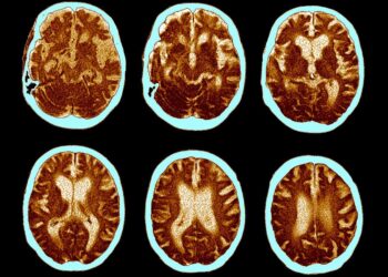 Nowe informacje o potencjale Ozempicu w leczeniu Alzheimera już w 2025 roku