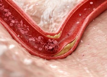 Terapia nowotworów może zwiększać ryzyko zawału serca i udaru poprzez zakłócenie regulacji układu odpornościowego w tętnicach