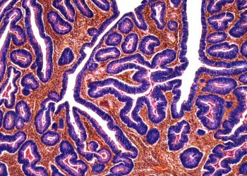 Wzrost zachorowań na raka jelita grubego wśród młodych ludzi na całym świecie