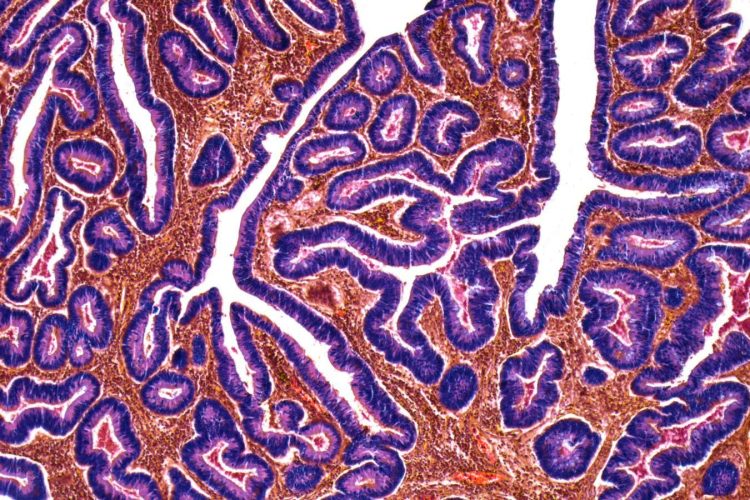 Wzrost zachorowań na raka jelita grubego wśród młodych ludzi na całym świecie