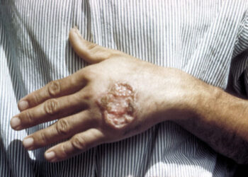 Brazylijska roślina obiecującym środkiem w walce z groźną chorobą tropikalną - leiszmaniozą