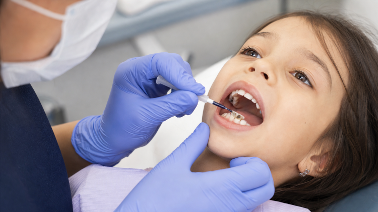 Dentysta nakłada fluorek diaminy srebra na ubytek bez użycia wiertła