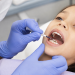 Dentysta nakłada fluorek diaminy srebra na ubytek bez użycia wiertła